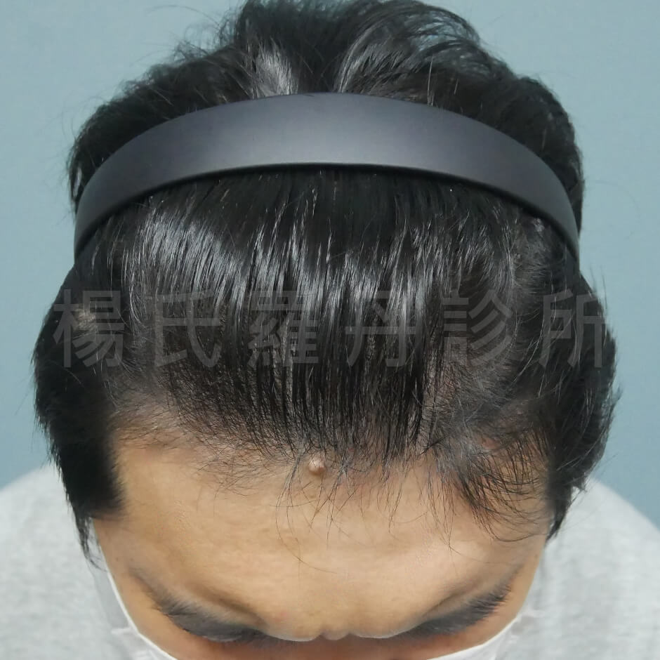 ARTAS 禿頭 植髮手術 植髮